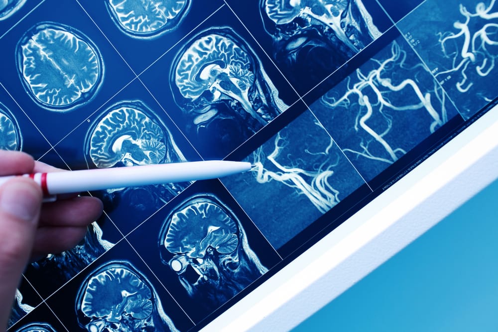 vascular dementia